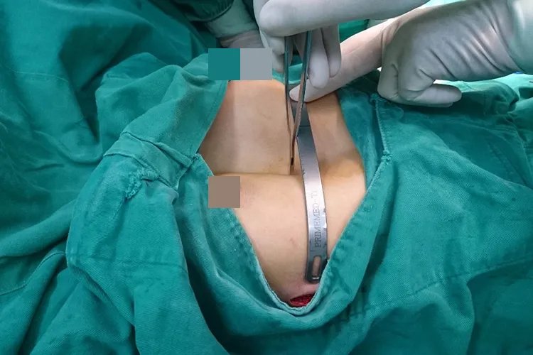 女生漏斗胸图片