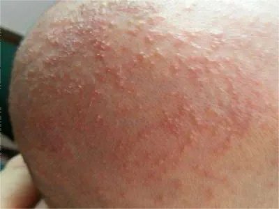 奶癣小红疙瘩图片