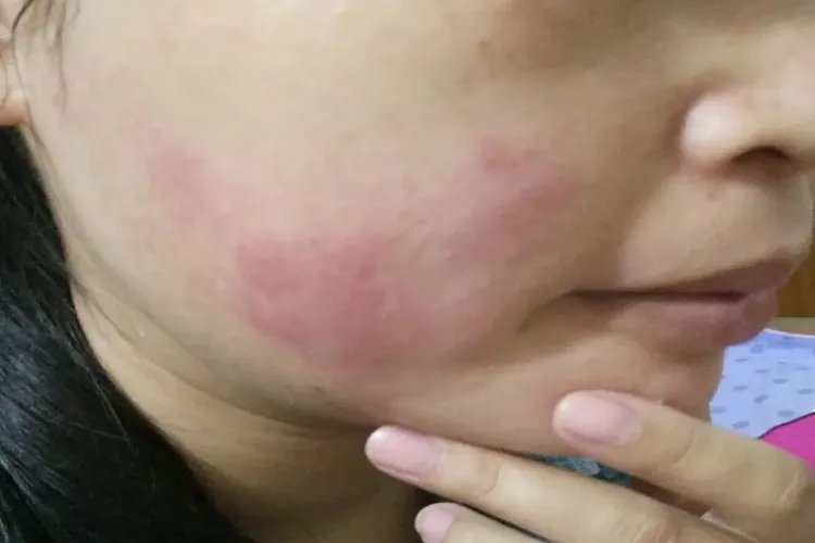 过敏长什么样图片