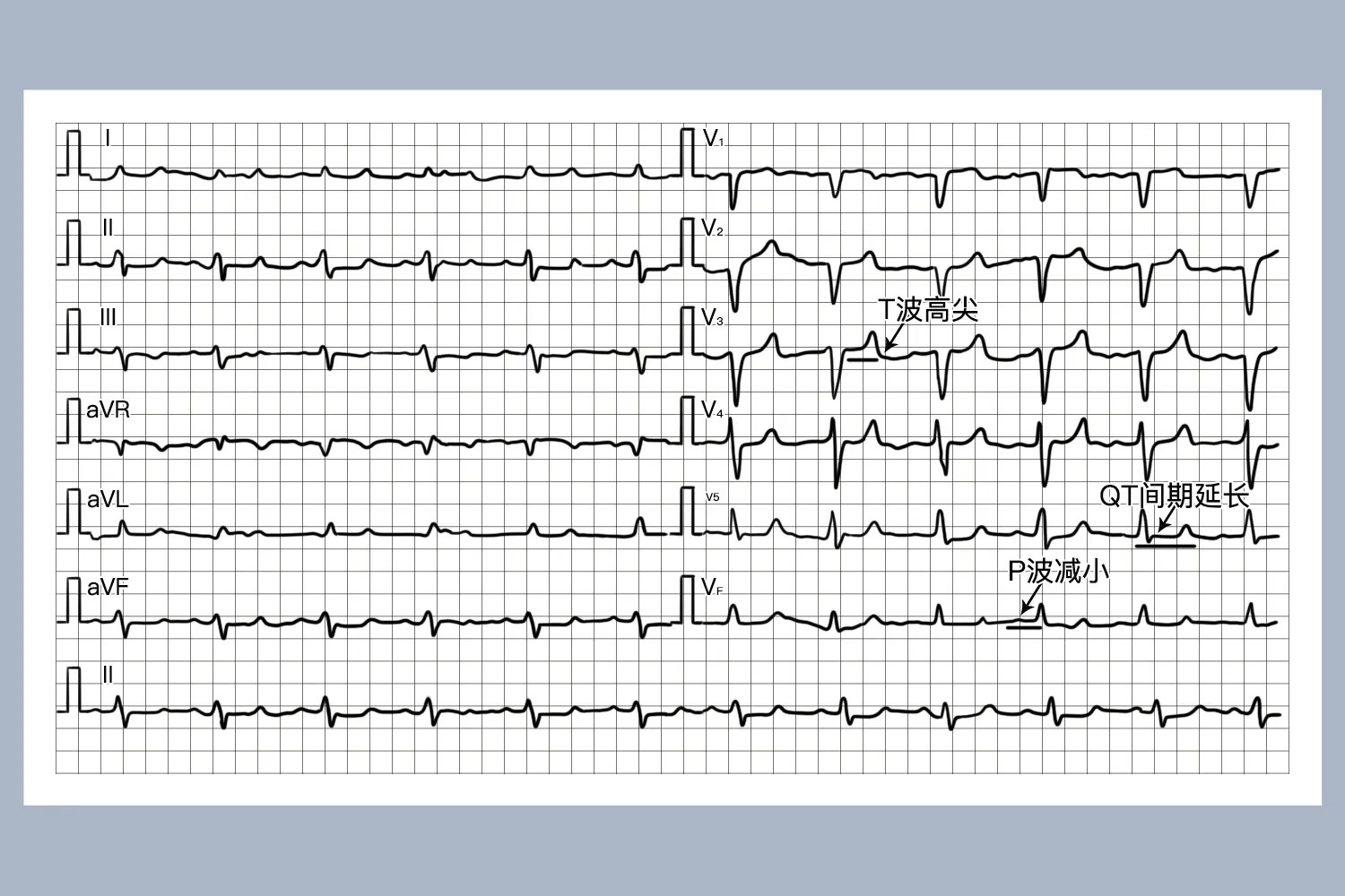 高钾心电图