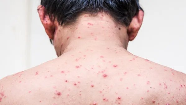 背后长痘痘怎么办