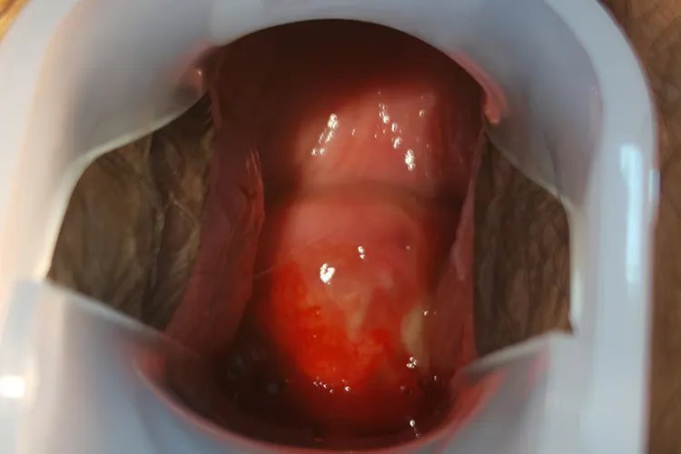 宫颈癌是什么样子实图