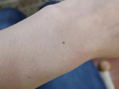 交界痣黑痣图片