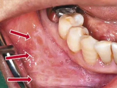 扁平苔藓斑图片