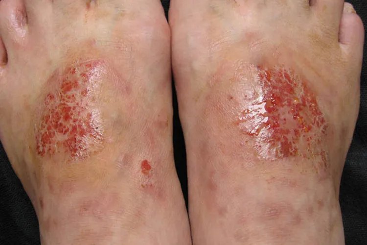 湿疹初期图片