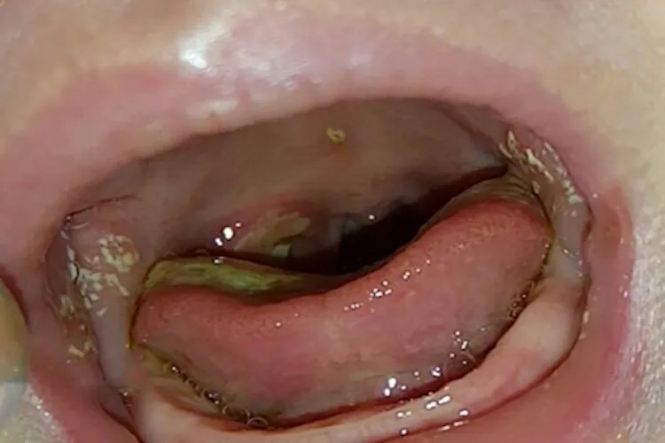 新生儿鹅口疮症状图片