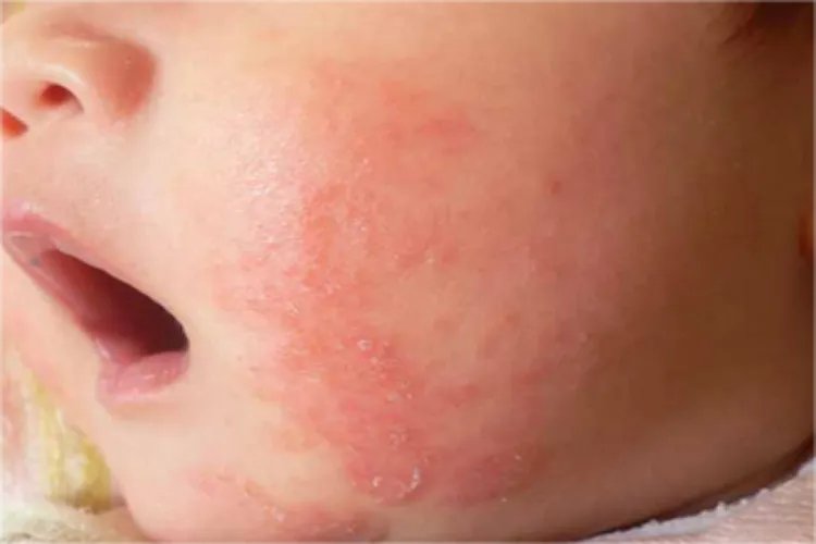 新生儿湿疹初期症状图片大全