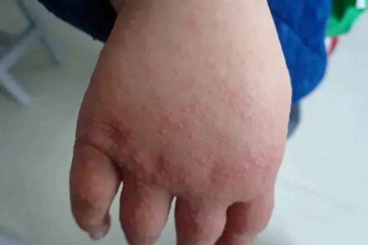 宝宝身上出现很多小红疹图片