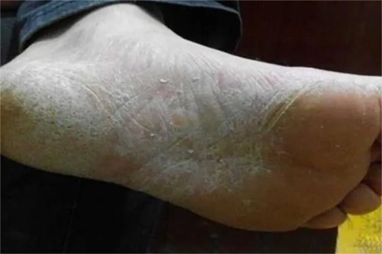 脚部皮炎图片和症状