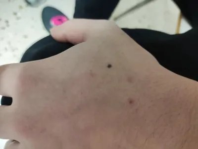 交界痣黑痣图片