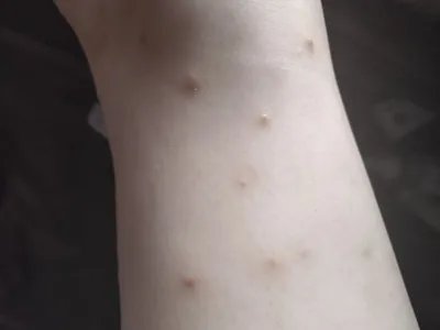 跳蚤叮咬小疙瘩图片