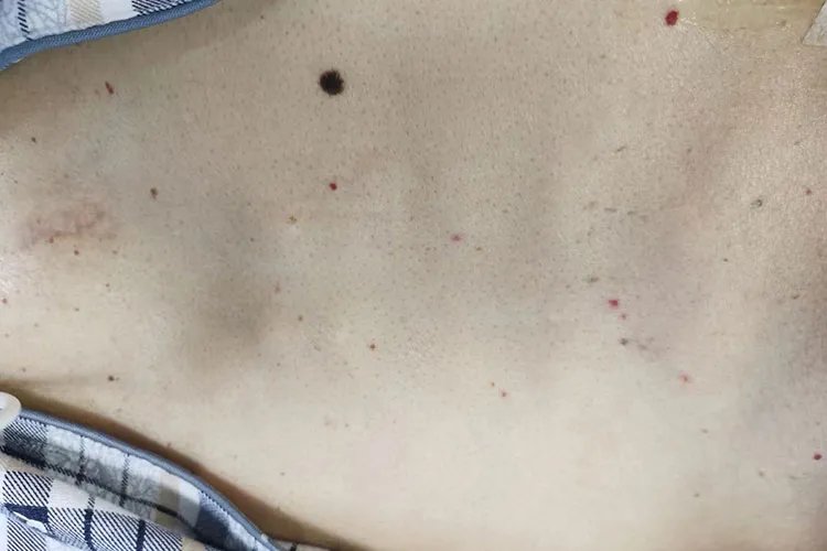 蜘蛛痣特征图片