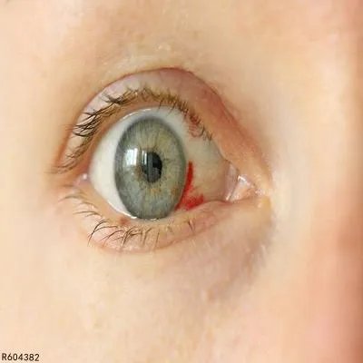 角膜移植后排斥怎么办