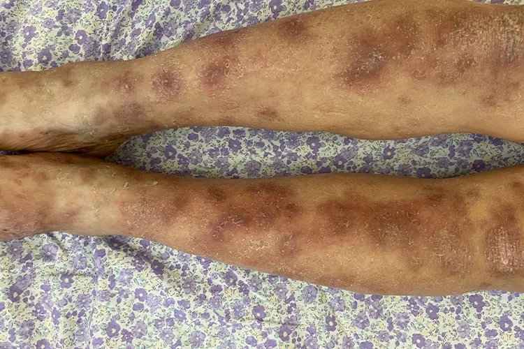 皮肤病湿疹对照图片