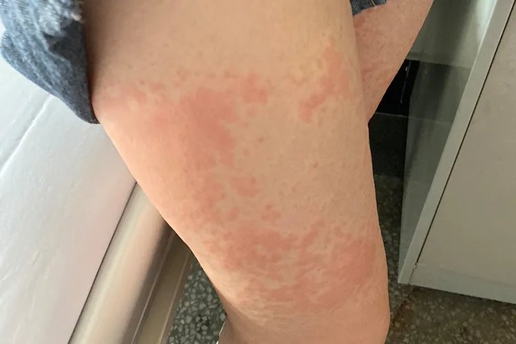 皮炎图片和症状用什么药