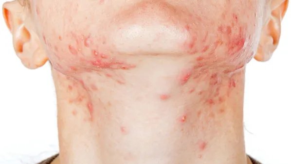 激光祛痘一般多少钱