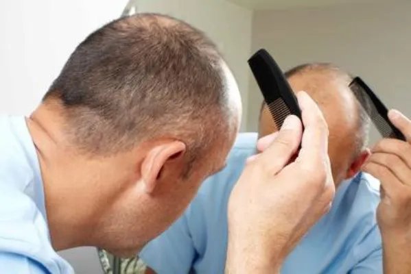 脱发严重该如何解决