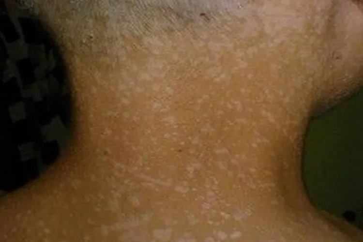 脖子上花斑癣图片大全