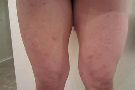 大腿内侧红斑不痛不痒图片