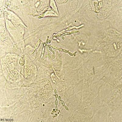 铁线虫病怎么检查