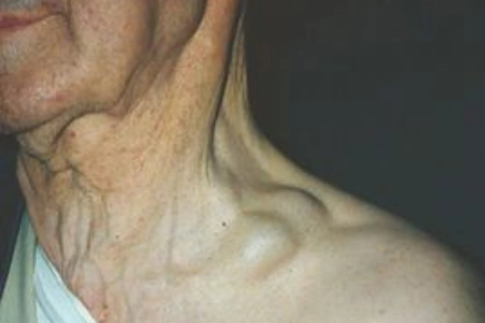 颈部淋巴结肿大图片，怎么消除