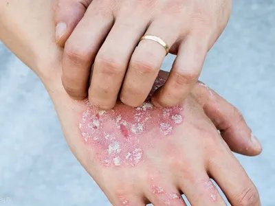 手部湿疹红斑图片