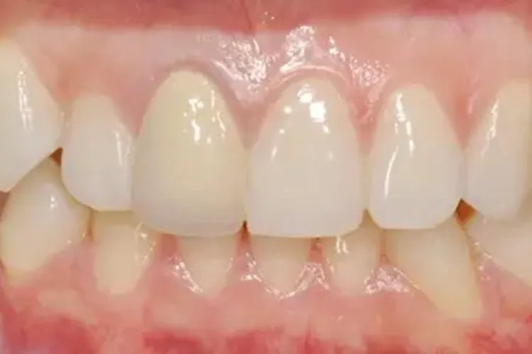 牙周病图片与正常牙齿图片