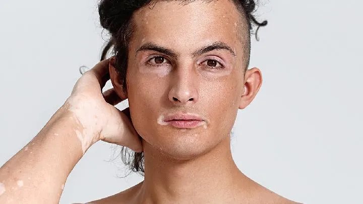 白癜风能治愈吗？怎么治？