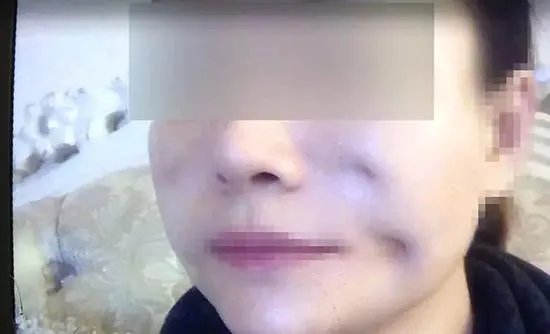 女子脸部整容整出八个坑整形机构人员怎么说？