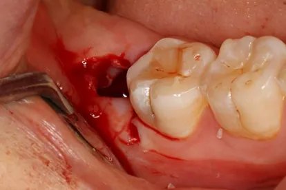 拔牙后七天窟窿恢复图