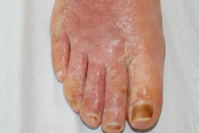 脚上皮肤病大全图