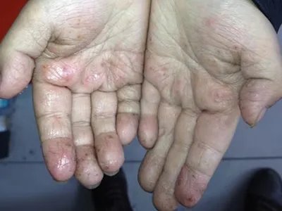 手部湿疹红斑图片