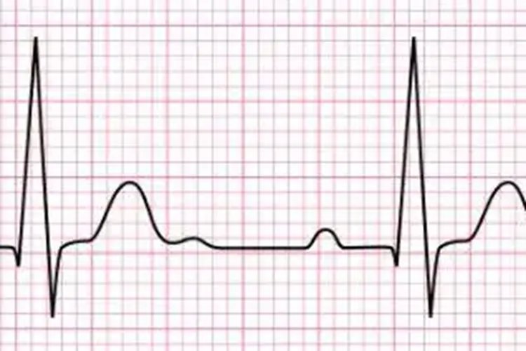 正常的心电图图片