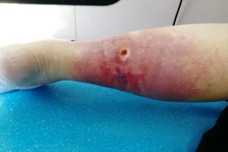 被蜱虫咬后十天伤口的图片