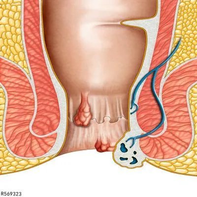 荣昌肛泰使用方法 荣昌肛泰使用注意事项是什么