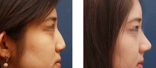 广州整容隆鼻多少钱