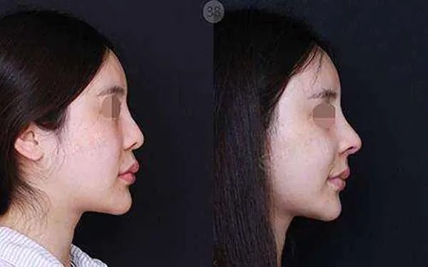 成都整形医院哪家做玻尿酸隆鼻好