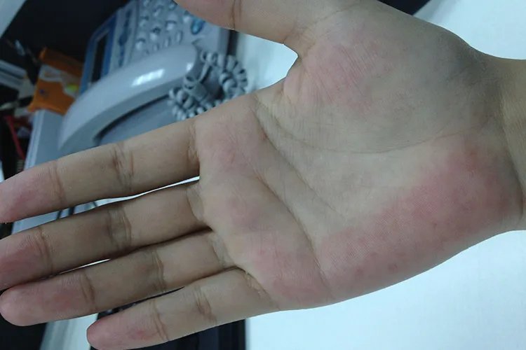 蜘蛛痣特征图片