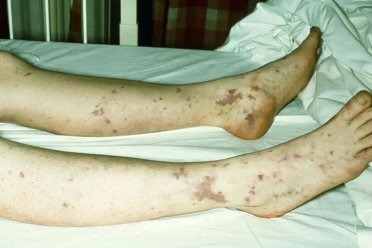 白血病红点图片