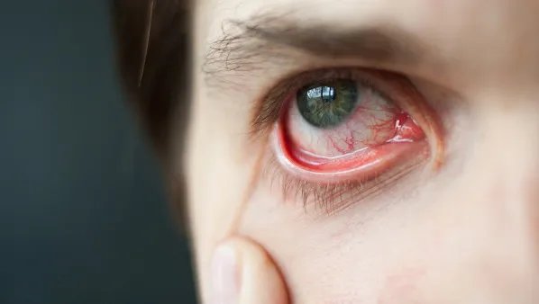 眼睛有红血丝怎么办 如何预防眼睛红血丝