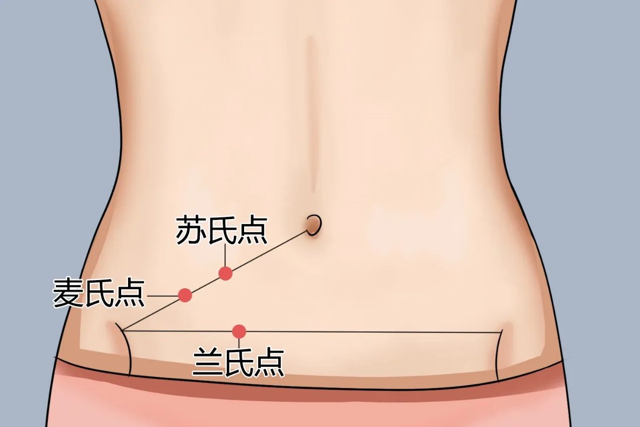 女性阑尾炎位置示意图