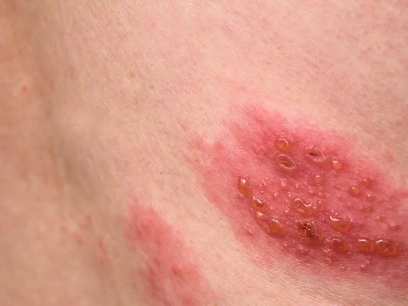 荨麻疹血管炎是什么