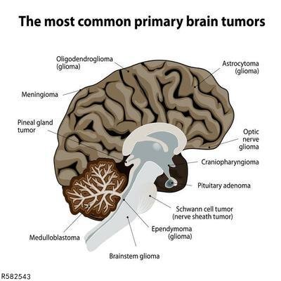 胶质母细胞瘤做什么检查可以知道