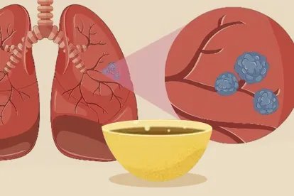 小陷胸汤能治肺结节吗