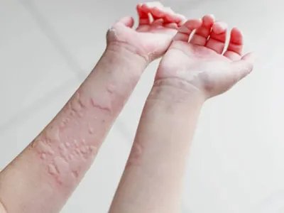 运动诱导性荨麻疹症状图片