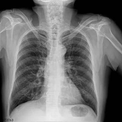 肺部结节是怎么回事