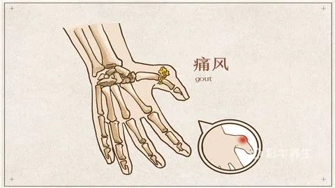 痛风怎么治疗最有效的方法