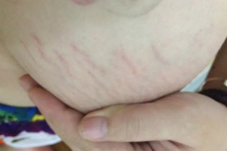 胸部妊娠纹图片