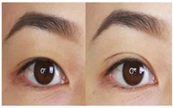 做双眼皮修复哪里好