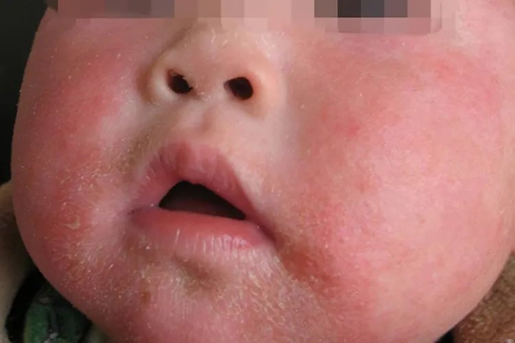 新生儿湿疹初期症状图片大全